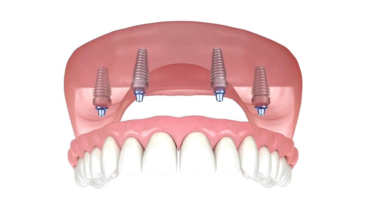Diagram of dentures secured with dental implants