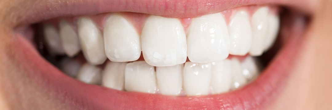 Exclusive Whitening Offer £375