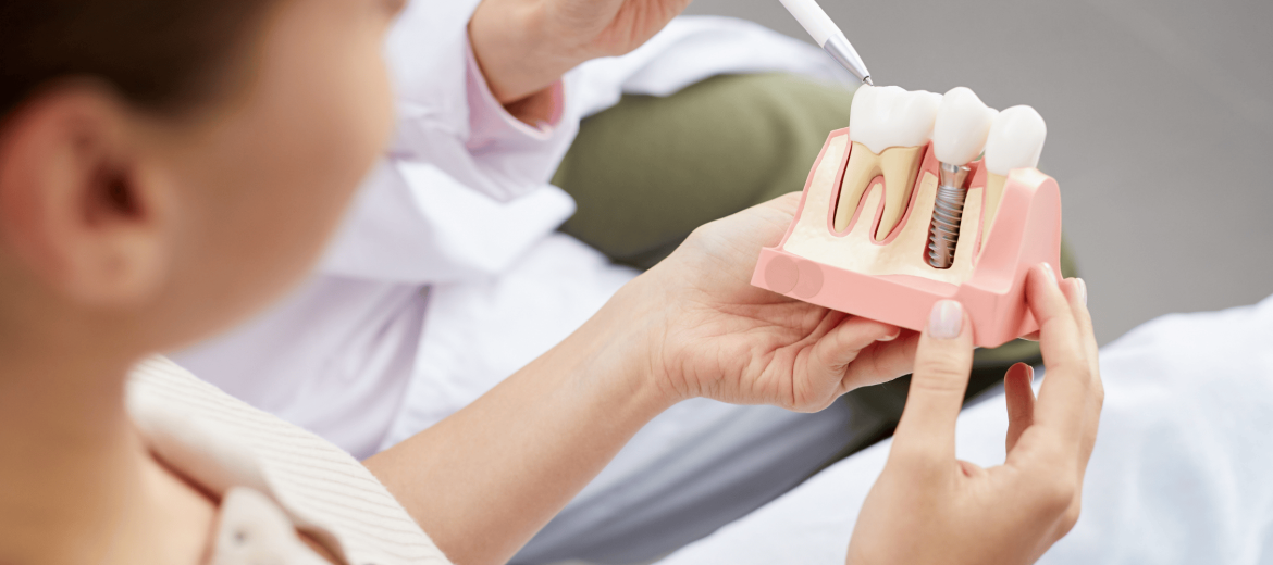 Dental Implants